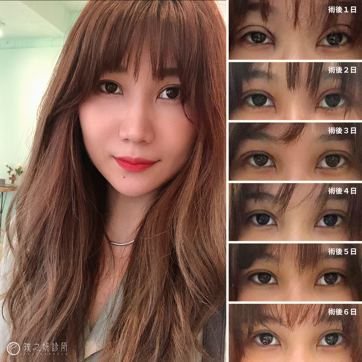 术后1~6日