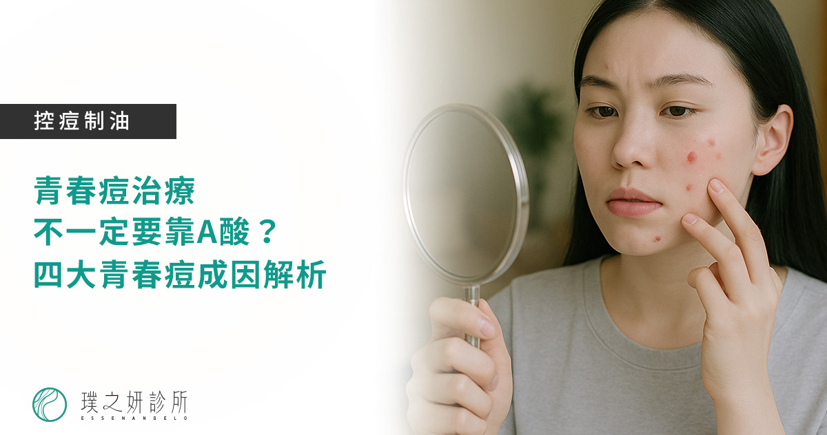青春痘治療，不一定要靠A酸？ 四大青春痘成因解析
