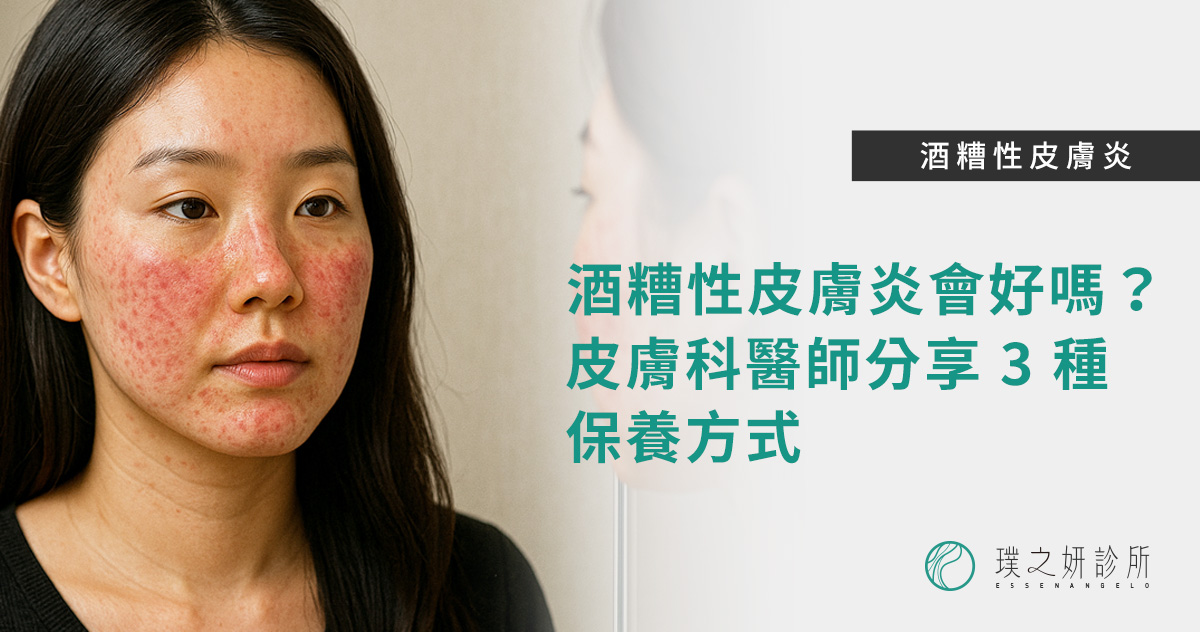酒糟性皮膚炎會好嗎?